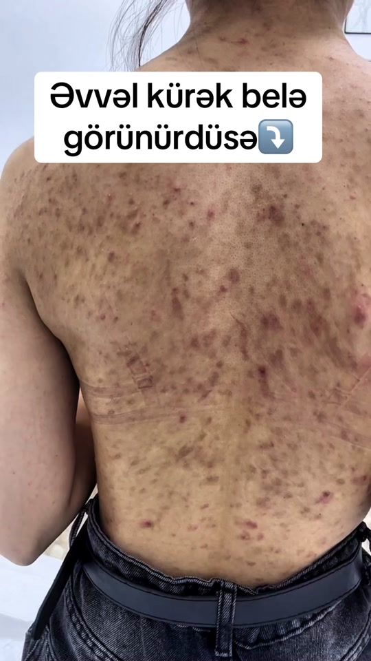 TikTok video thumbnail by dermatoloq_feride