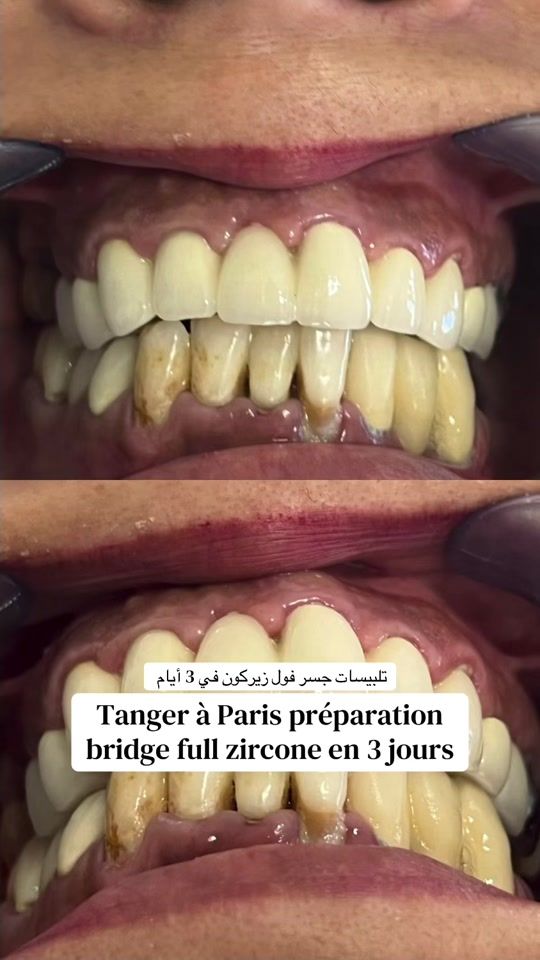 TikTok video thumbnail by elkkhamlichidental