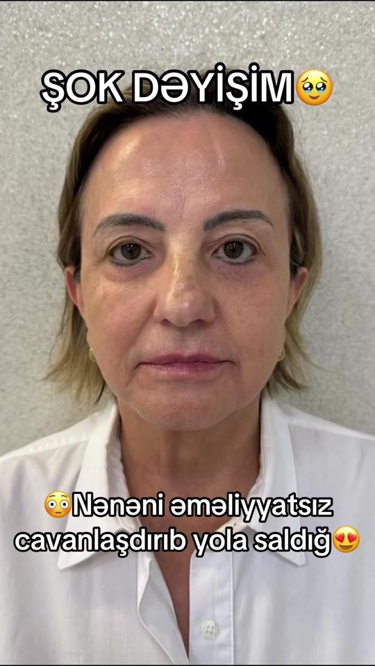 TikTok video thumbnail by dr.amrahmehdiyev