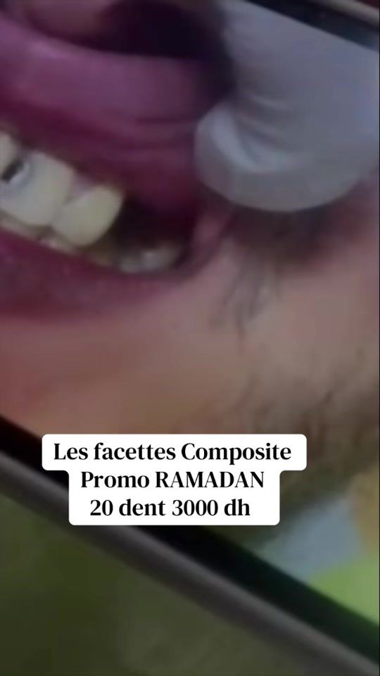 TikTok video thumbnail by elkkhamlichidental
