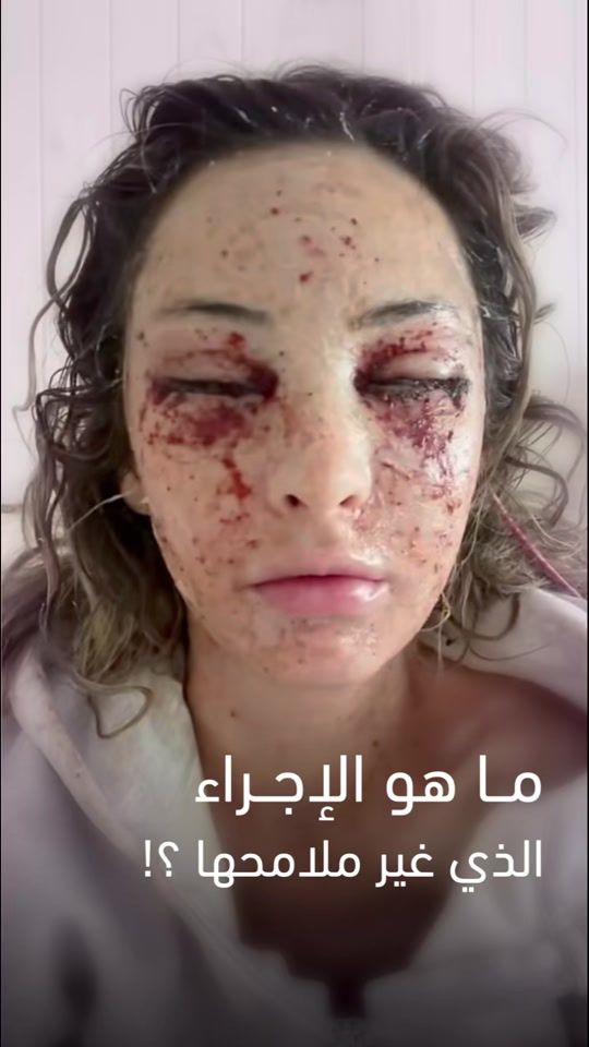 TikTok video thumbnail by drfadinassr