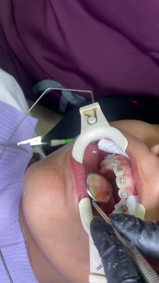 TikTok video thumbnail by maodental