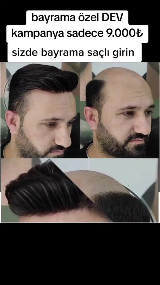TikTok video thumbnail by bigboss_protez_sac
