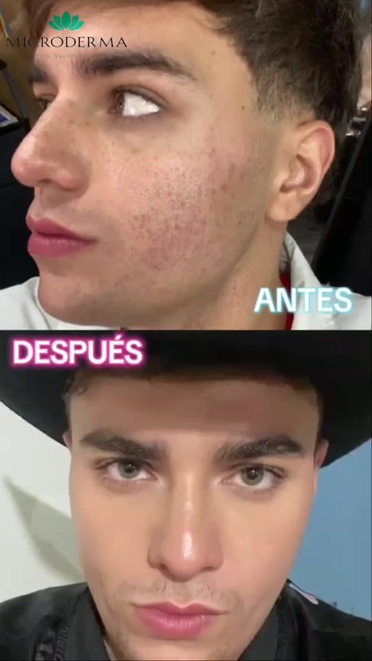 TikTok video thumbnail by microderma_bolivia