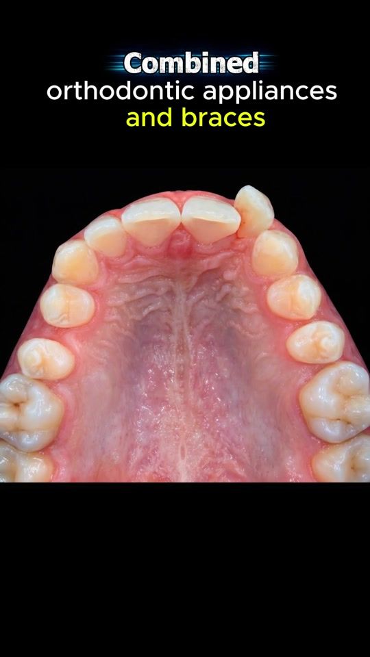 TikTok video thumbnail by nhakhoa.ocare