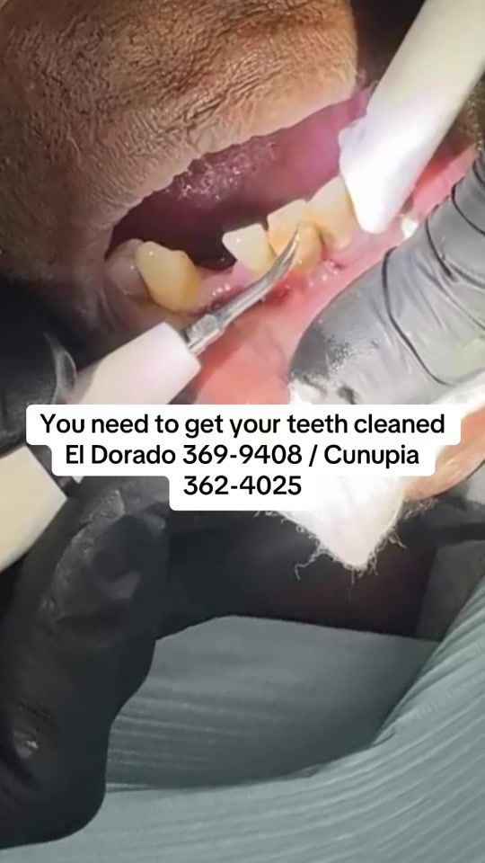 TikTok video thumbnail by thedentalhubtt