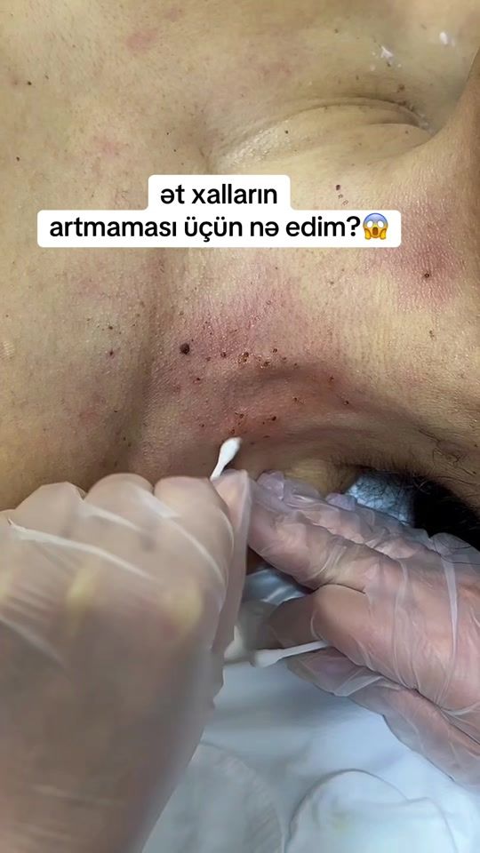 TikTok video thumbnail by dermatoloq_feride