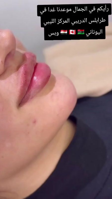 TikTok video thumbnail by dr.hend.almsiriu