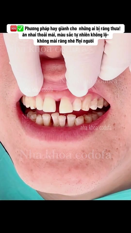 TikTok video thumbnail by nhakhoa_codofa