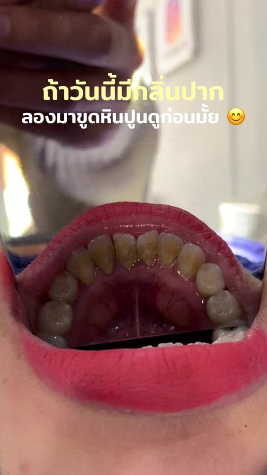 TikTok video thumbnail by hugyim_dental