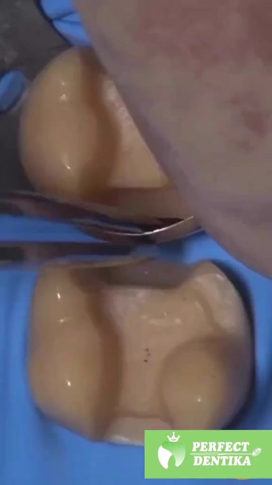 TikTok video thumbnail by perfect_dentika