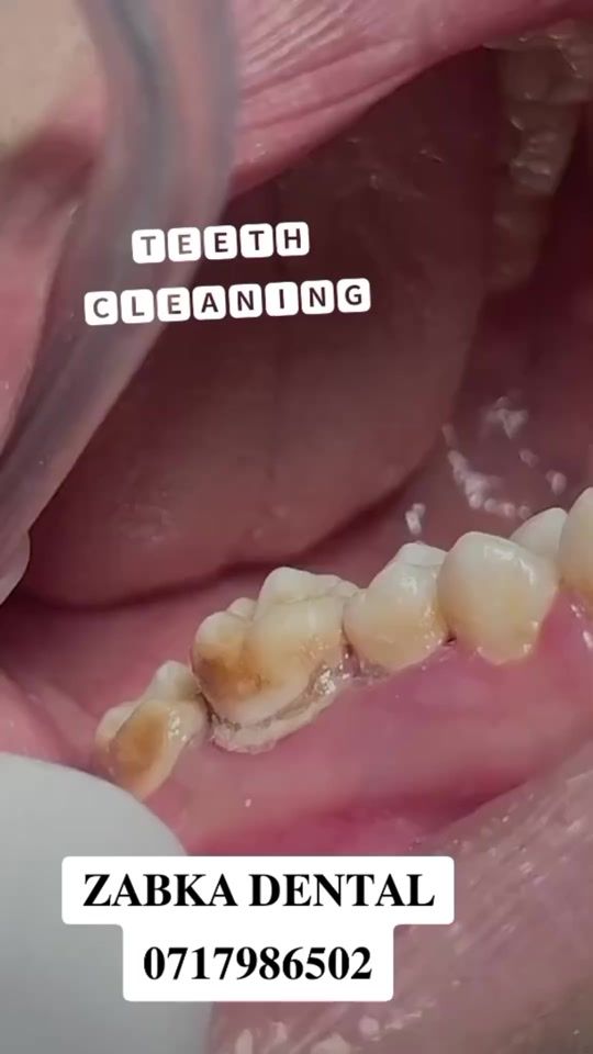 TikTok video thumbnail by zabkadentalservices