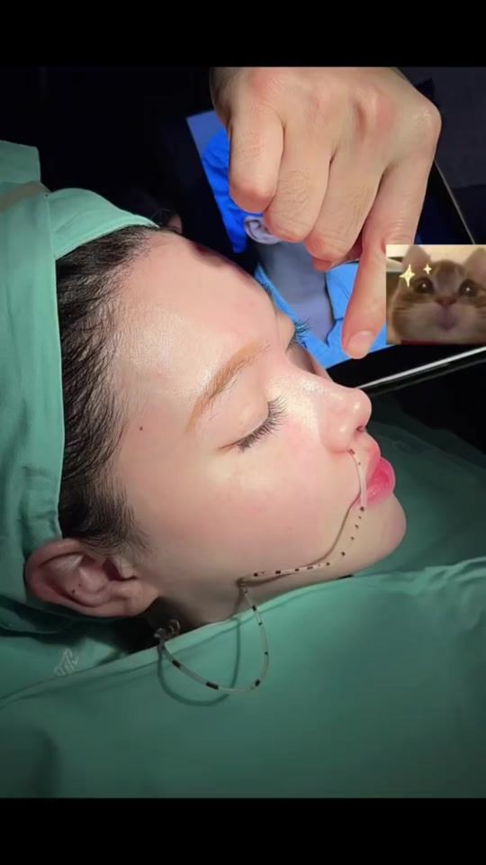 TikTok video thumbnail by leouplasticsurgery
