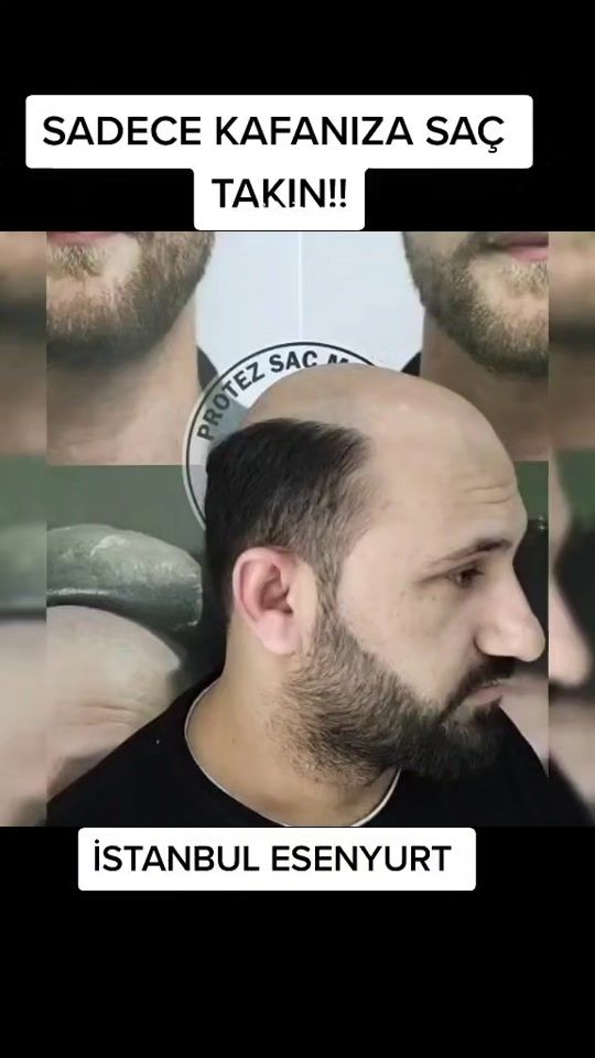 TikTok video thumbnail by bigboss_protez_sac