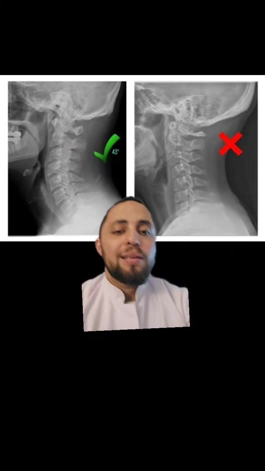TikTok video thumbnail by drhashemosteo
