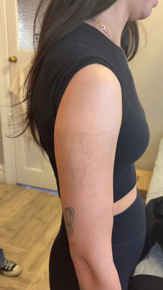 TikTok video thumbnail by swift_tattoo_removal