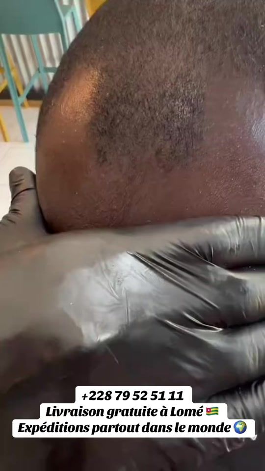 TikTok video thumbnail by minoxidiltogo