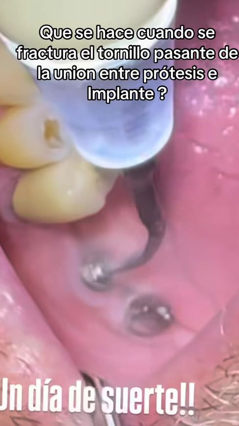 TikTok video thumbnail by dr.cuevasss