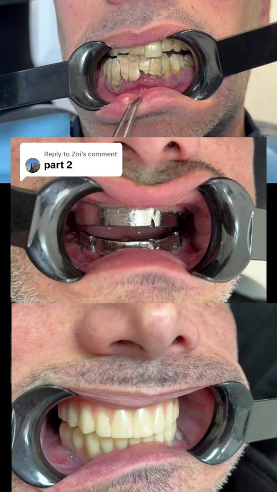 TikTok video thumbnail by keoldent