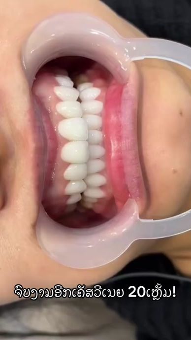 TikTok video thumbnail by tsmiledental