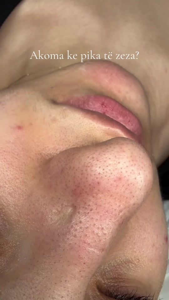 TikTok video thumbnail by skin_therapyy