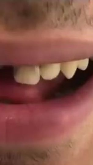 TikTok video thumbnail by dental_lab3