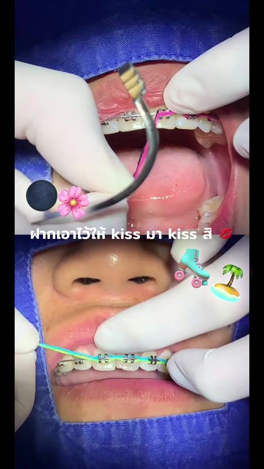 TikTok video thumbnail by hugyim_dental