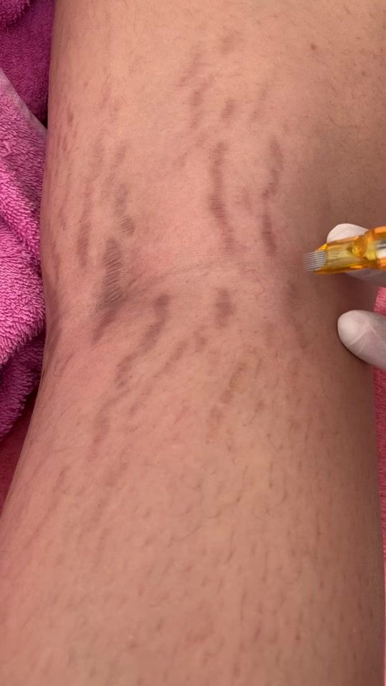 TikTok video thumbnail by elasticity_therapy_