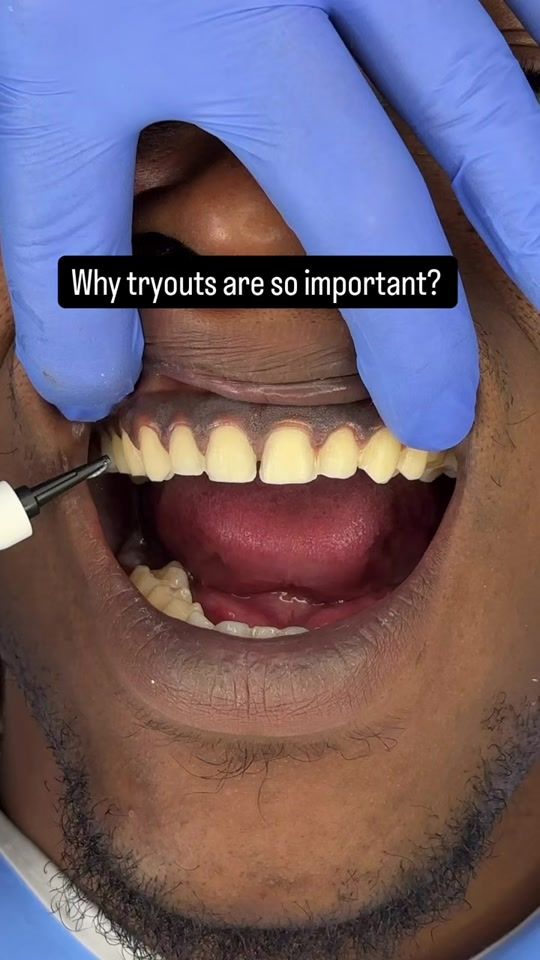 TikTok video thumbnail by arcdentistry
