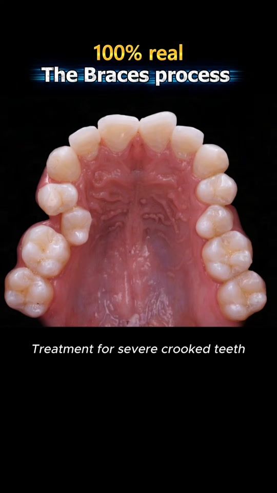 TikTok video thumbnail by nhakhoa.ocare