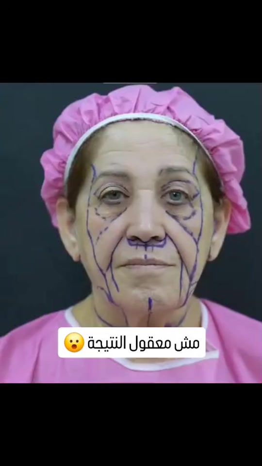 TikTok video thumbnail by beirutclinics