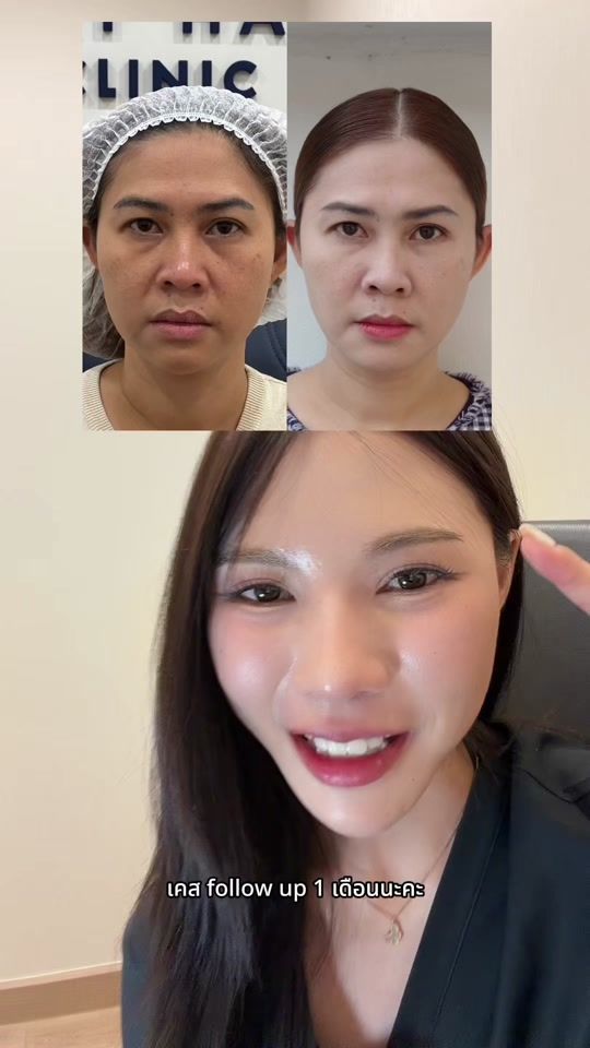 TikTok video thumbnail by dr.k.kayclinic