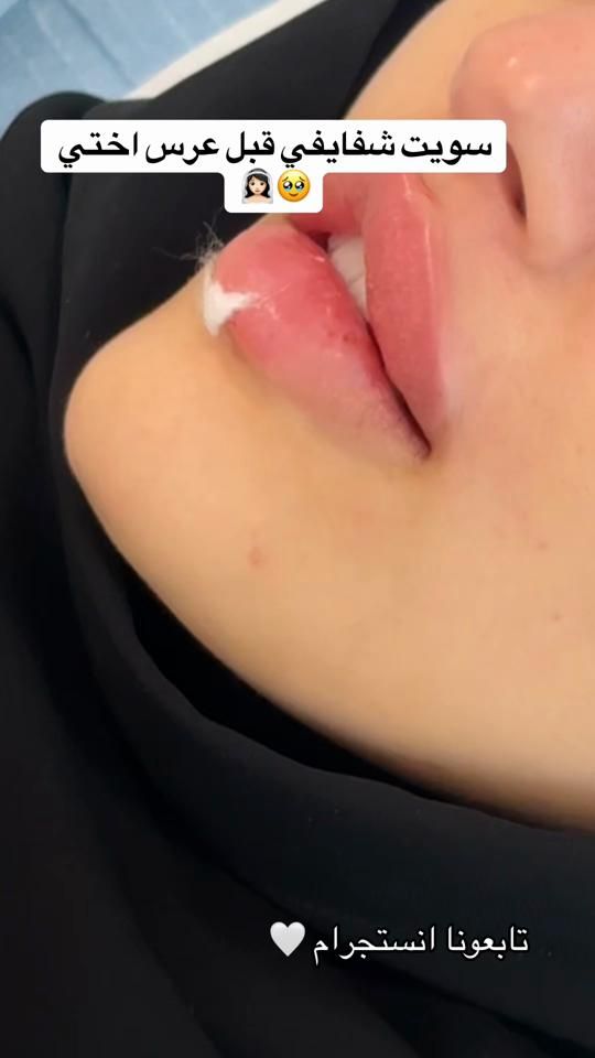 TikTok video thumbnail by beirutclinic